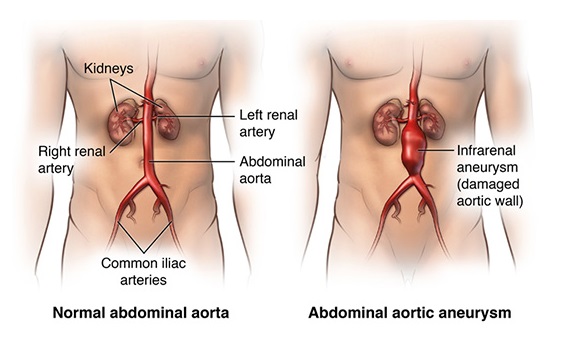 Diagrammatic Representation of Health Condition - Abdominal aortic aneurysm