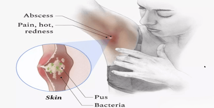 Common antibiotics like Flucloxacillin and Clindamycin in pill form.