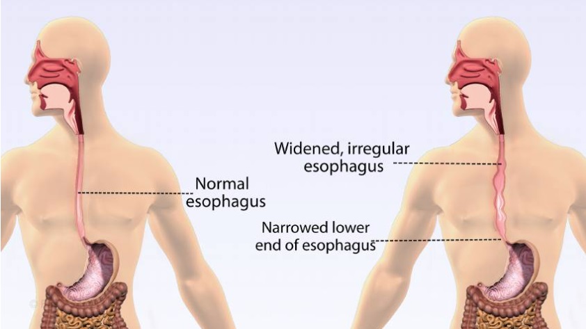 Illustration of the esophagus representing Achalasia