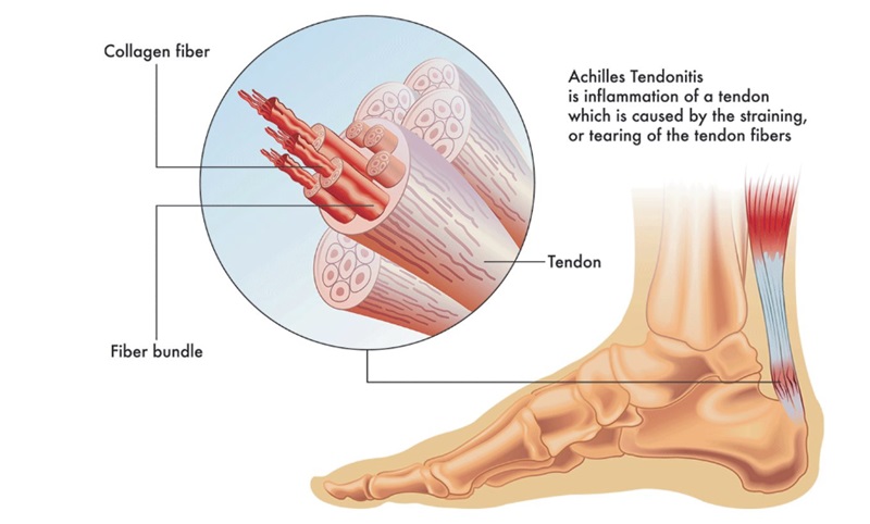 (Achilles Tendinitis Diagram): "Achilles Tendinitis: Understanding the Anatomy and Affected Area."