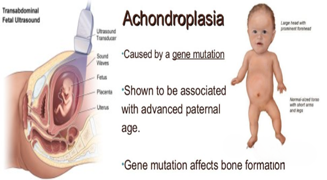 Image of a child with Achondroplasia: "Child with Achondroplasia displaying short limbs and enlarged head.